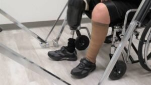 below knee residual limb