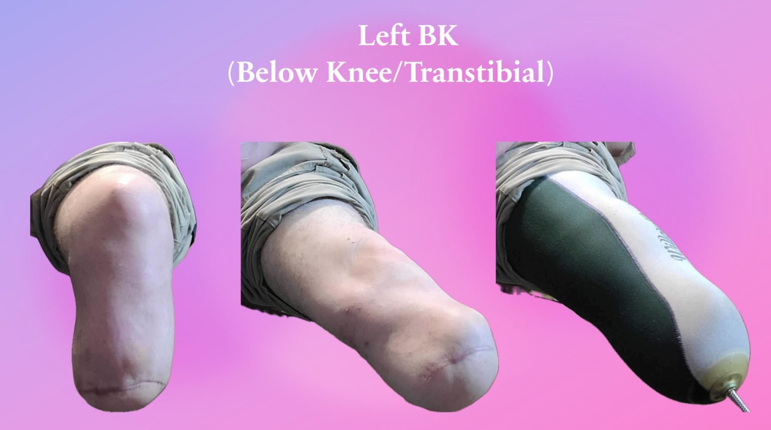 Prosthesis R Bka Residual Limb Awareness: Understanding and Mastering Your Below Knee ...
