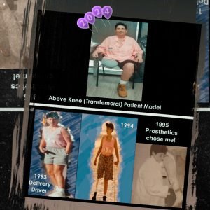 Amputee Rehab