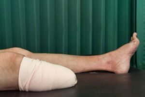 Below Knee Residual Limb
